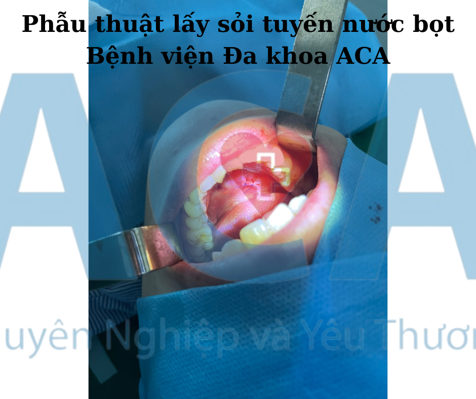 Phau-thuat-lay-soi-tuyen-nuoc-bot-Benh-vien-Da-khoa-ACA.png